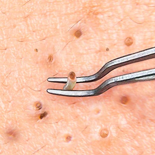 Close-up of an esthetician using precision blackhead tweezers to extract a blackhead safely and hygienically during a professional facial treatment