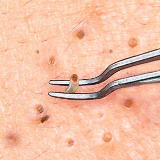 Close-up of an esthetician using precision blackhead tweezers to extract a blackhead safely and hygienically during a professional facial treatment