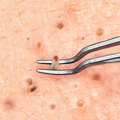 Close-up of an esthetician using precision blackhead tweezers to extract a blackhead safely and hygienically during a professional facial treatment